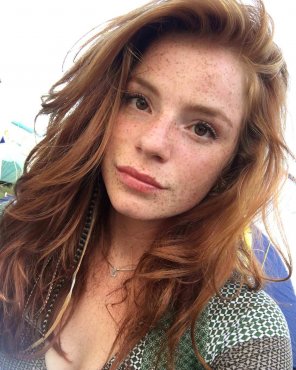 freckles