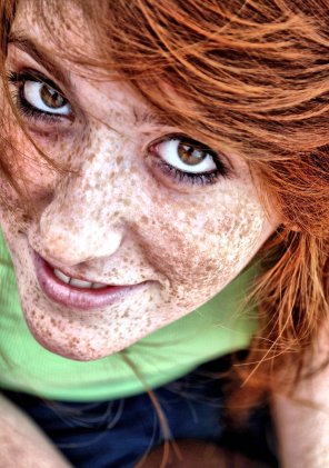 amateur photo Extreme freckles